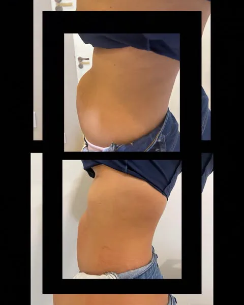 Post com antes e depois do abdômen